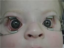 A baby's eyes opened with optical specula. This is not Lyra, but it is how she looks when they are used to remove and insert her lenses.